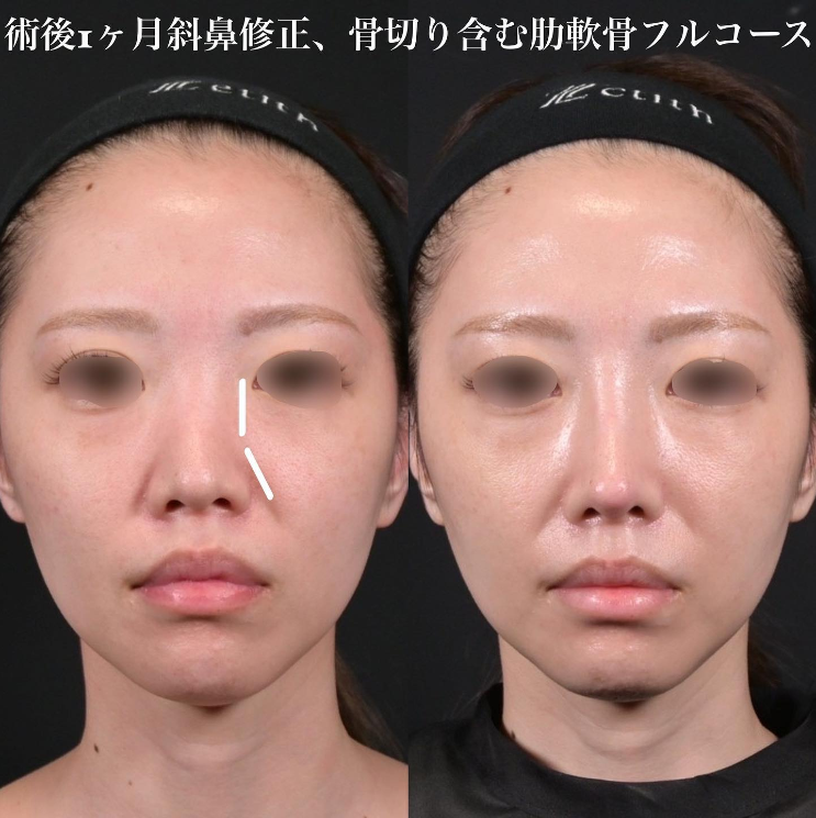 鉄医師による鼻のフルコースの施術前／施術後1ヶ月