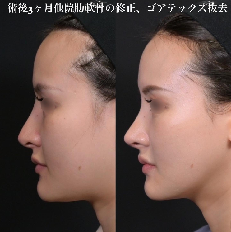 鉄医師による鼻のフルコースの施術前／施術後3ヶ月