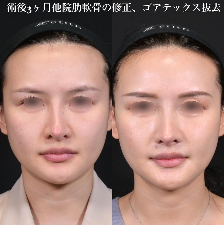鉄医師による鼻のフルコースの施術前／施術後3ヶ月 施術後 
