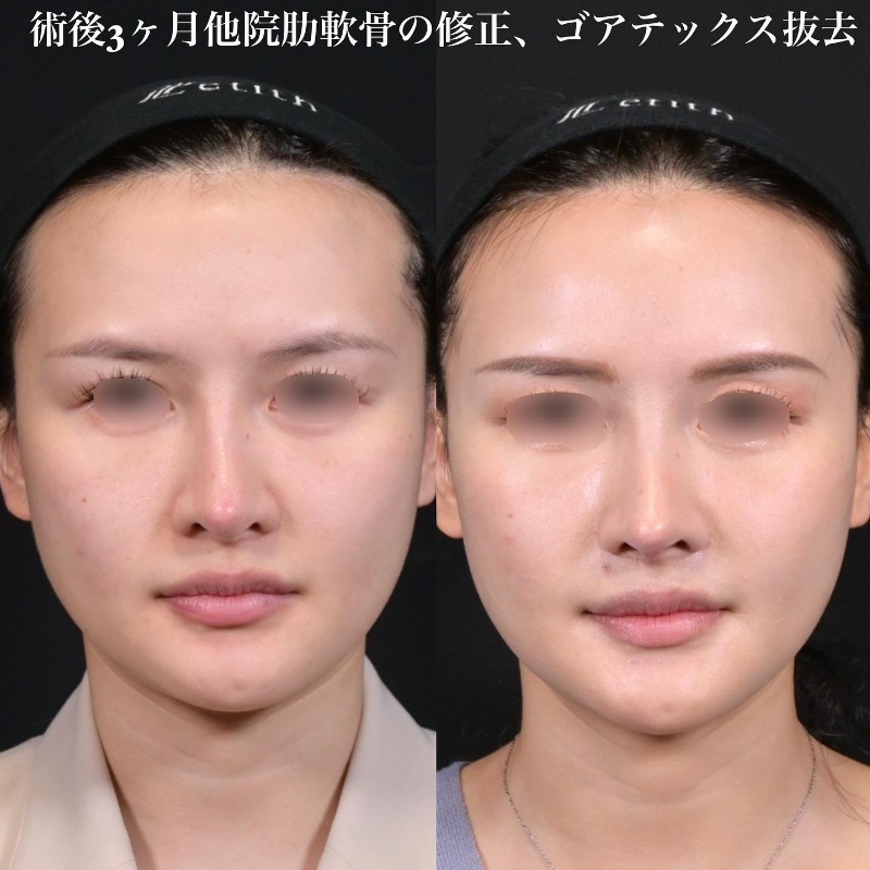 鉄医師による鼻のフルコースの施術前／施術後3ヶ月 หลัง 