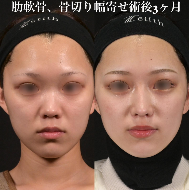 鉄医師による鼻のフルコースの施術前／施術後3ヶ月 施術後 