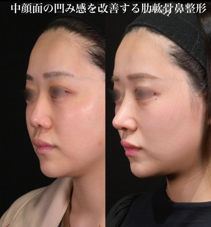 鉄医師による鼻のフルコースの施術前／施術後3ヶ月 施術後 