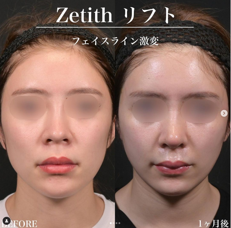 新井医師による糸リフトの施術前／施術後1週間