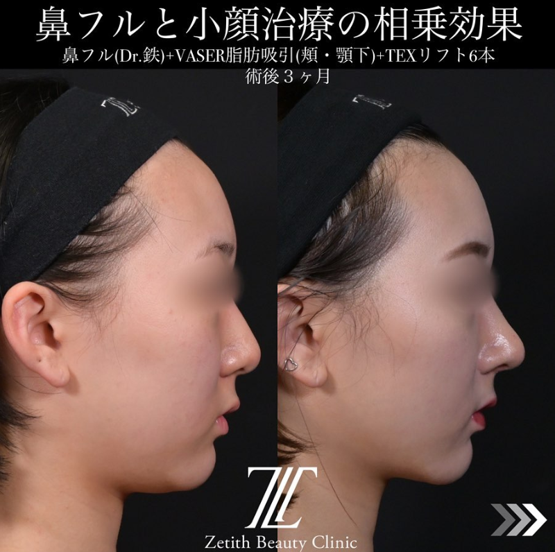 北村医師による脂肪吸引＋糸リフトンの施術前／施術後3ヶ月