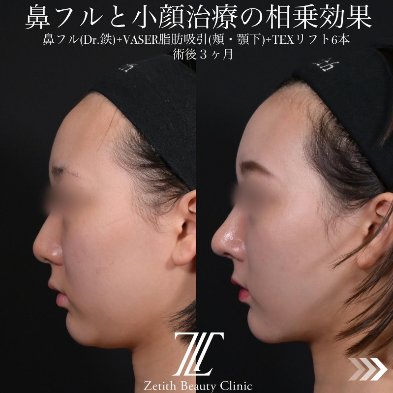 北村医師による脂肪吸引＋糸リフトンの施術前／施術後3ヶ月 施術後 