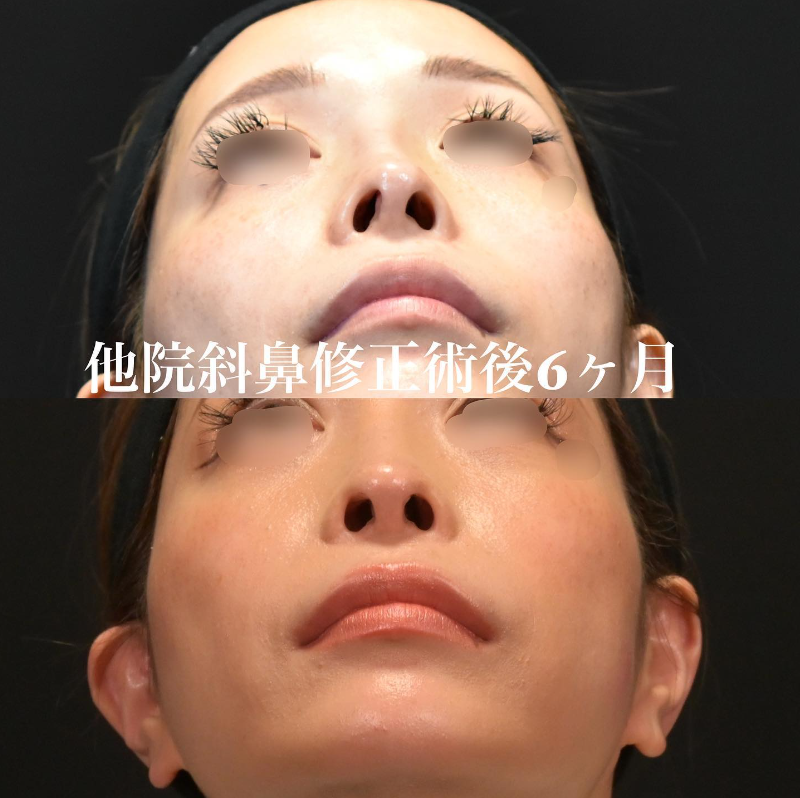鉄医師による鼻のフルコースの施術前／施術後6ヶ月