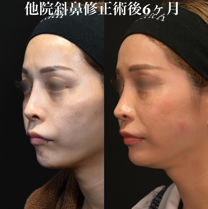 鉄医師による鼻のフルコースの施術前／施術後6ヶ月 After 