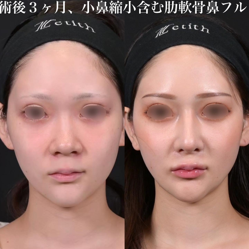 鉄医師による鼻のフルコースの施術前／施術後3ヶ月