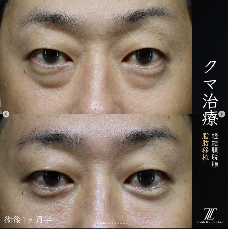 王医師によるクマ取りの施術前／施術後1ヶ月半