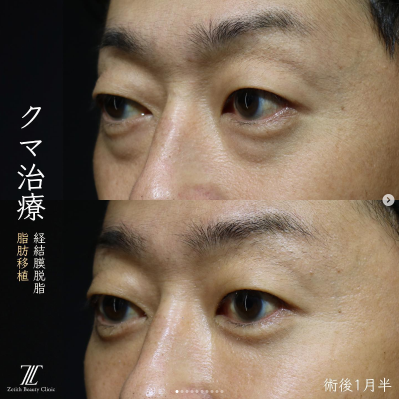 王医師によるクマ取りの施術前／施術後1ヶ月半 بعد 