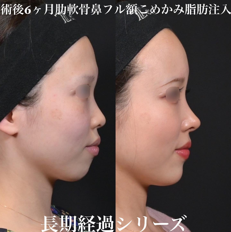 鉄医師による鼻のフルコースの施術前／施術後6ヶ月
