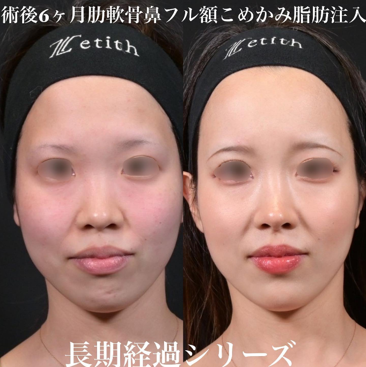 鉄医師による鼻のフルコースの施術前／施術後6ヶ月 หลัง 