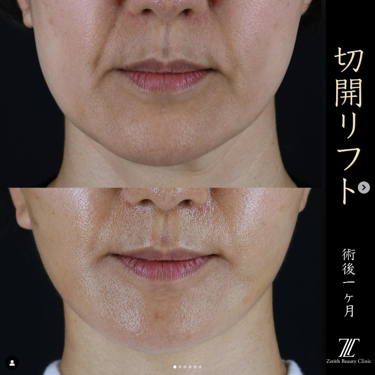 王医師による切開フェイスリフトの施術前／施術後1ヶ月