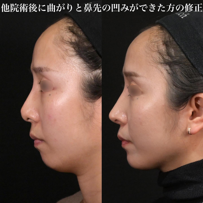 鉄医師による鼻のフルコースの施術前／施術後3ヶ月