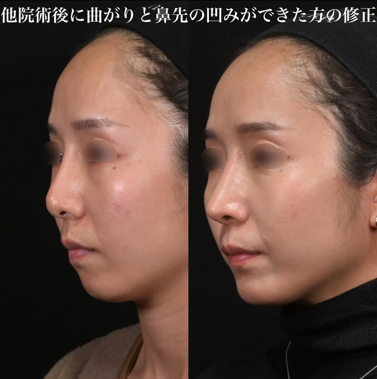 鉄医師による鼻のフルコースの施術前／施術後3ヶ月 术后 