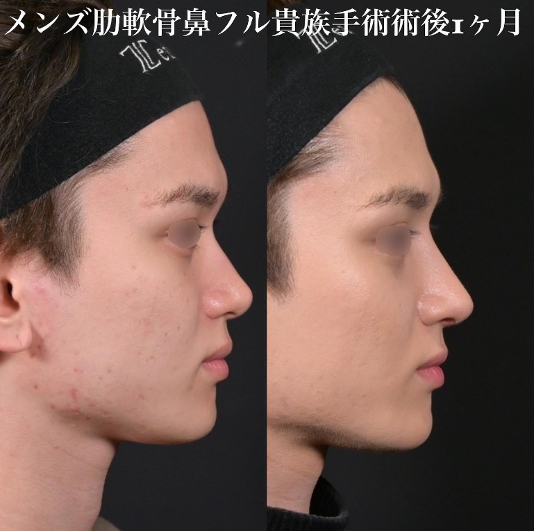 鉄医師による鼻のフルコースの施術前／施術後1ヶ月