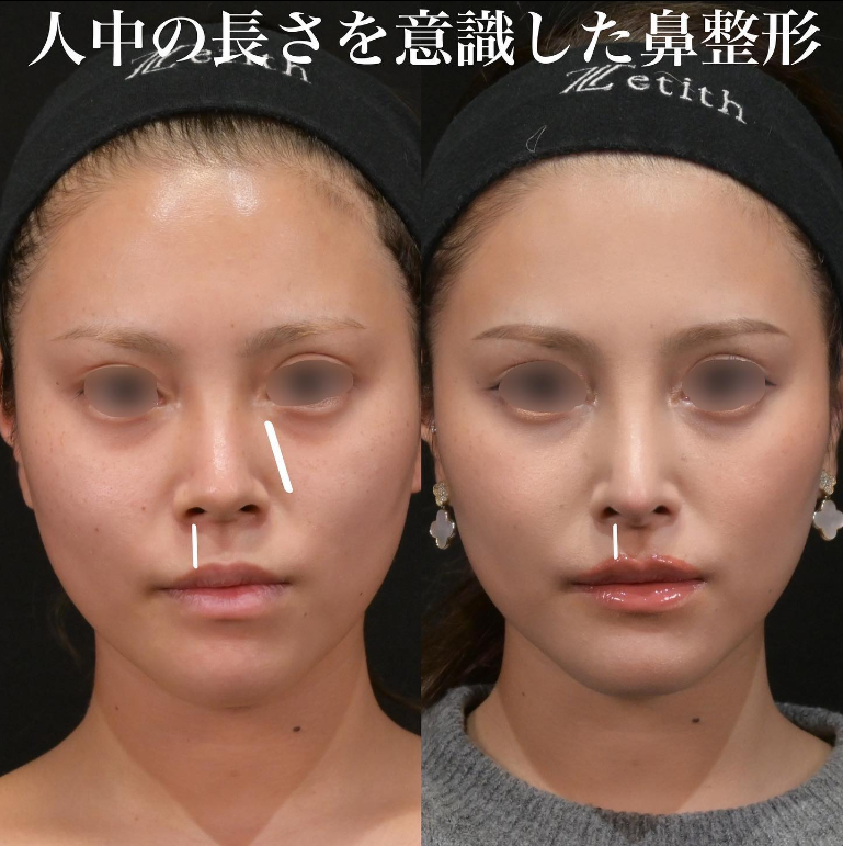 Nose | By Concern — Zetith Beauty Clinic