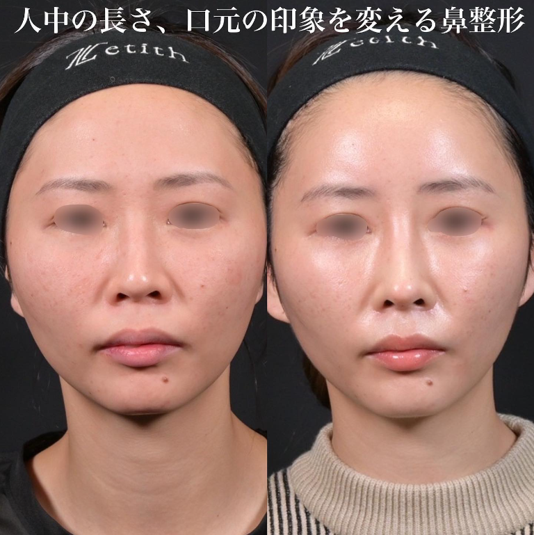鉄医師による鼻のフルコースの施術前／施術後1ヶ月 施術後 