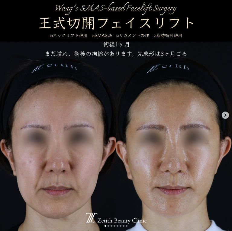 王医師による切開フェイスリフトの施術前／施術後1ヶ月 After 