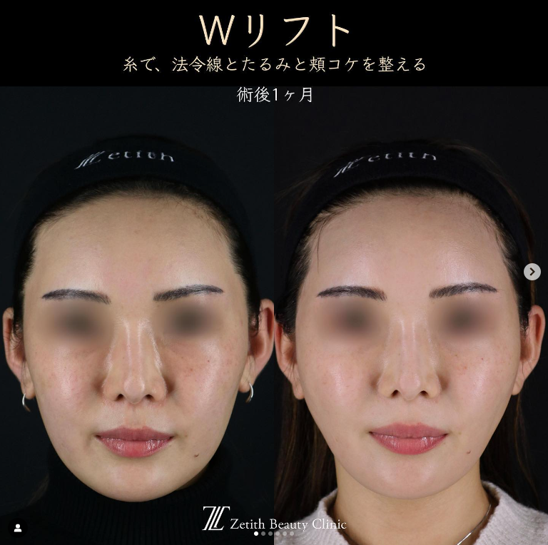 王医師による糸リフトの施術前／施術後1ヶ月