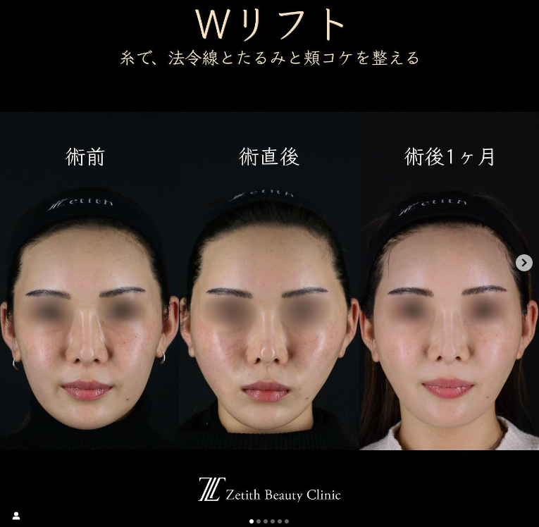 王医師による糸リフトの施術前／施術後1ヶ月 施術後 