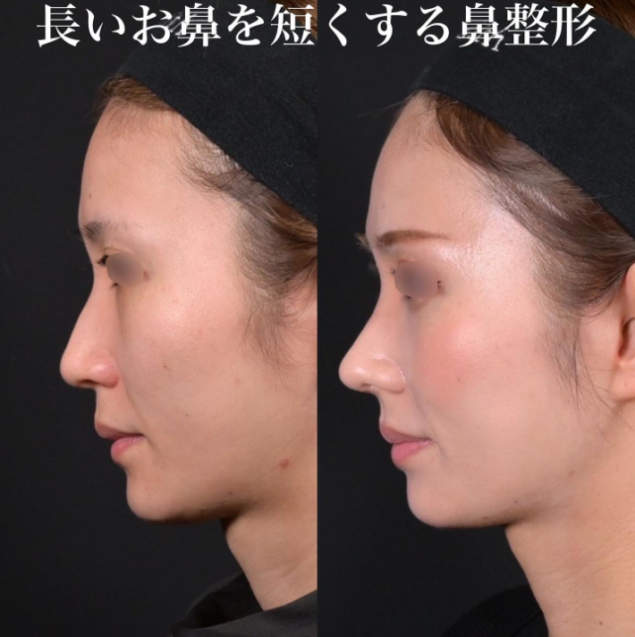 鉄医師による鼻のフルコースの施術前／施術後1ヶ月