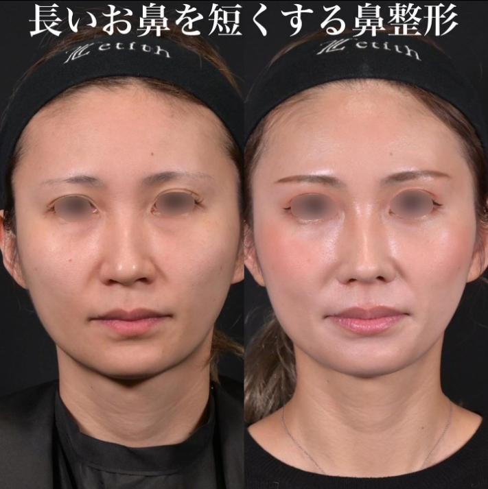 鉄医師による鼻のフルコースの施術前／施術後1ヶ月 施術後 