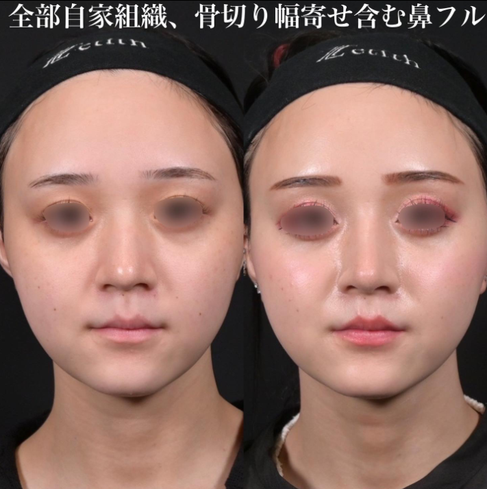 鉄医師による鼻のフルコースの施術前／施術後3ヶ月 施術後 