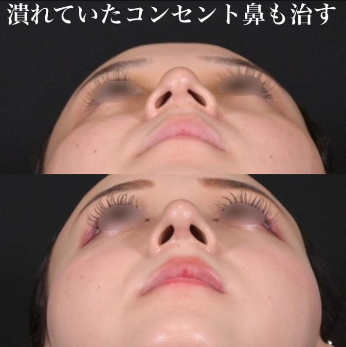 鉄医師による鼻のフルコースの施術前／施術後3ヶ月