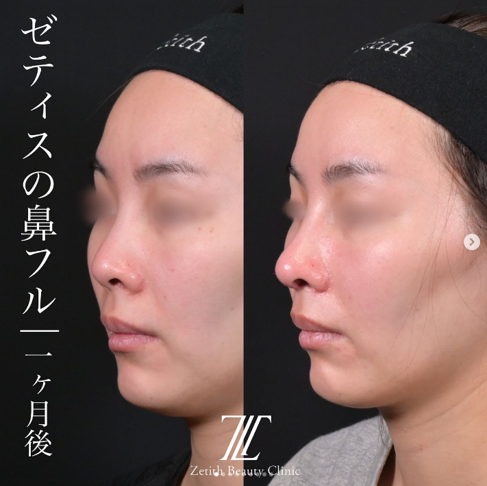 守屋医師による鼻整形の施術前／施術後1ヶ月