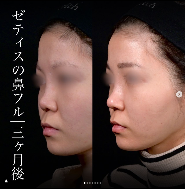 守屋医師による鼻整形の施術前／施術後3ヶ月