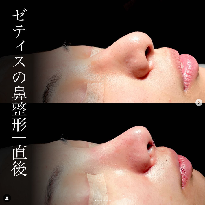 守屋医師による鼻整形の施術前／施術直後