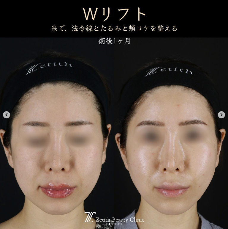 王医師による糸リフトの施術前／施術後1ヶ月 Sau 