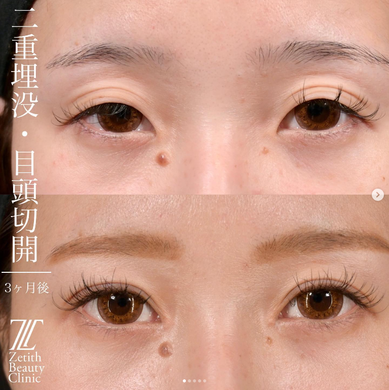 上木原医師による二重埋没法の施術前／施術後3ヶ月
