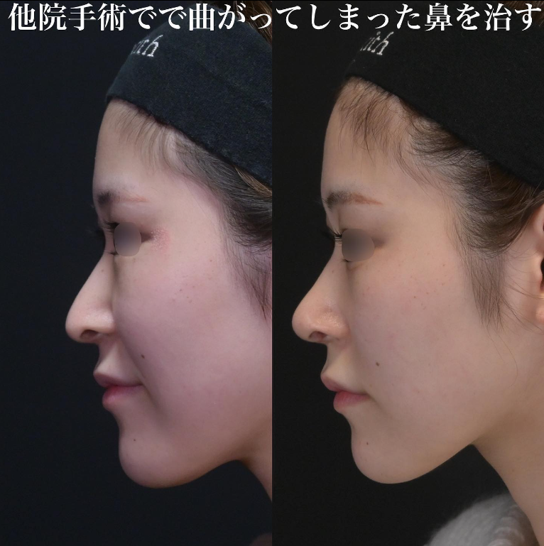 鉄医師による鼻のフルコースの施術前／施術後1ヶ月 施術後 