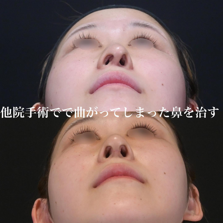 鉄医師による鼻のフルコースの施術前／施術後1ヶ月