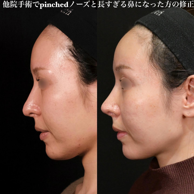 鉄医師による鼻のフルコースの施術前／施術後3ヶ月