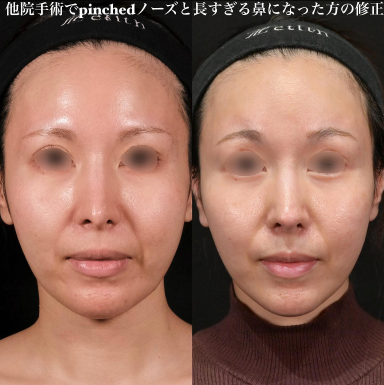 鉄医師による鼻のフルコースの施術前／施術後3ヶ月 施術後 