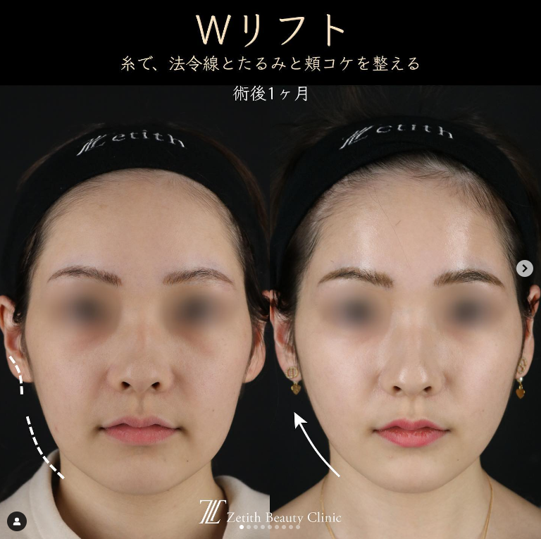 王医師による糸リフトの施術前／施術後1ヶ月