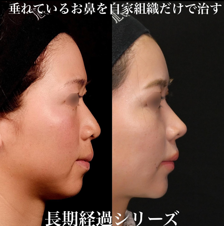 鉄医師による鼻のフルコースの施術前／施術後9ヶ月