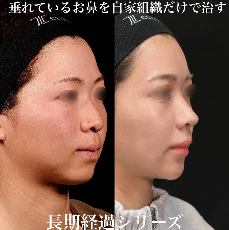鉄医師による鼻のフルコースの施術前／施術後9ヶ月 Дараа 