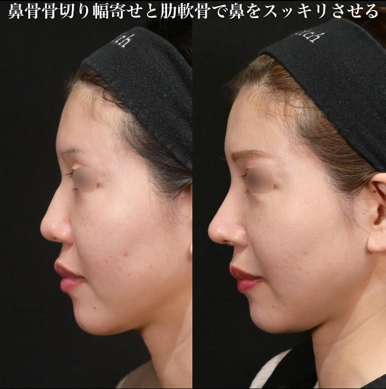 鉄医師による鼻のフルコースの施術前／施術後1ヶ月 术后 