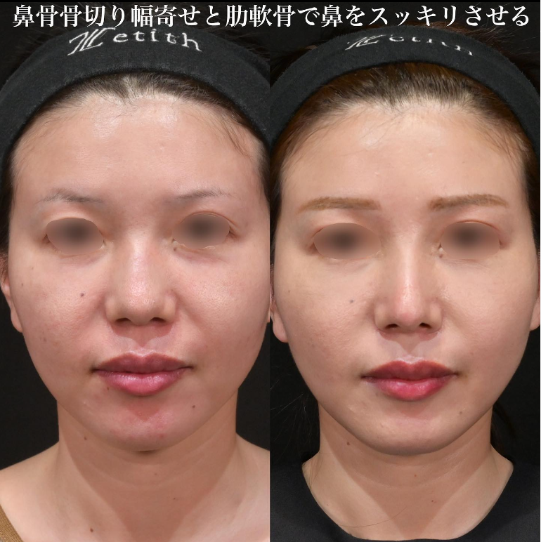 鉄医師による鼻のフルコースの施術前／施術後1ヶ月