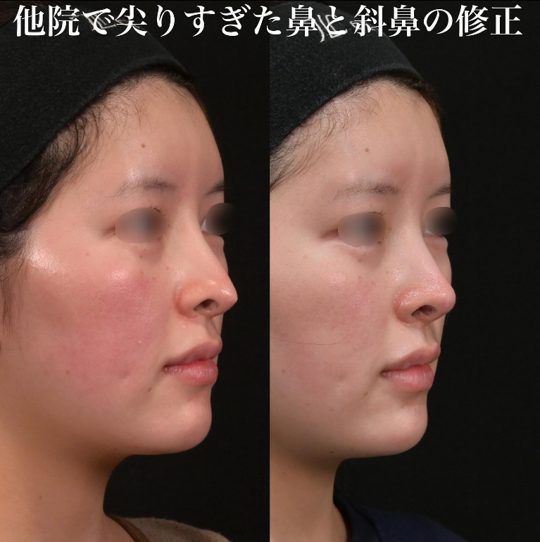 鉄医師による鼻のフルコースの施術前／施術後3ヶ月