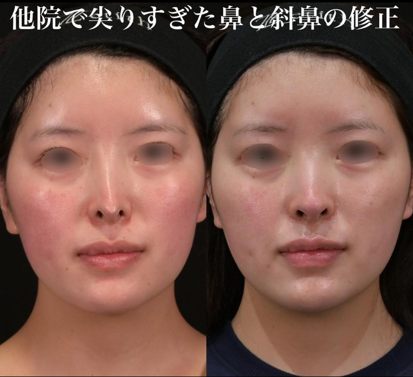 鉄医師による鼻のフルコースの施術前／施術後3ヶ月 施術後 