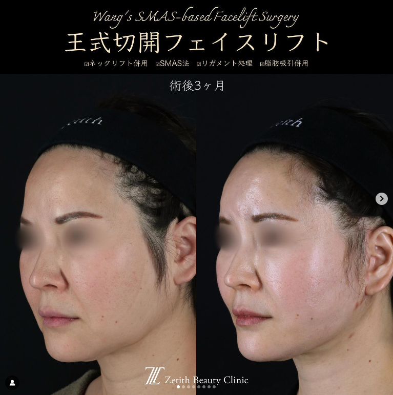 王医師によるフェイスネックリフトの施術前／施術後3ヶ月