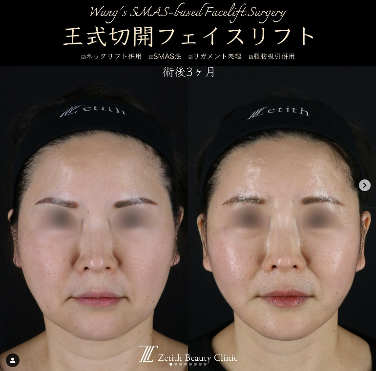 王医師によるフェイスネックリフトの施術前／施術後3ヶ月 Sau 