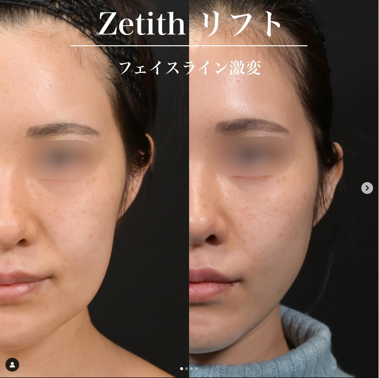 新井医師による糸リフトの施術前／施術後1週間