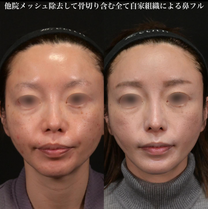 鉄医師による鼻のフルコースの施術前／施術後酸3ヶ月