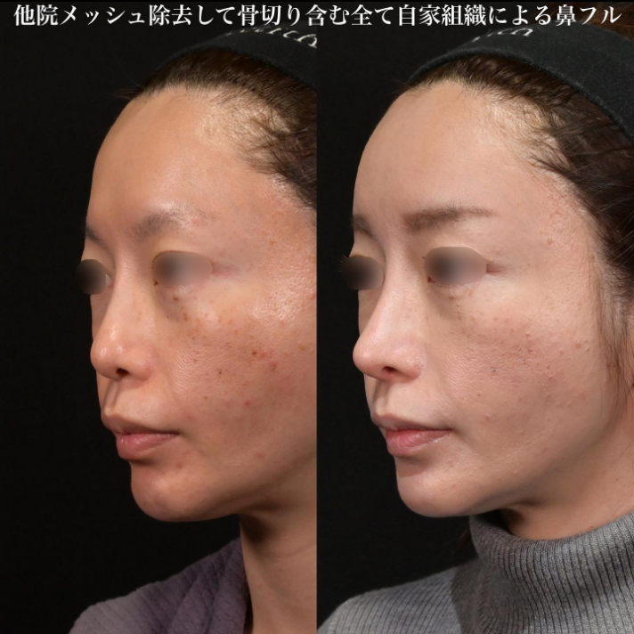 鉄医師による鼻のフルコースの施術前／施術後酸3ヶ月 After 
